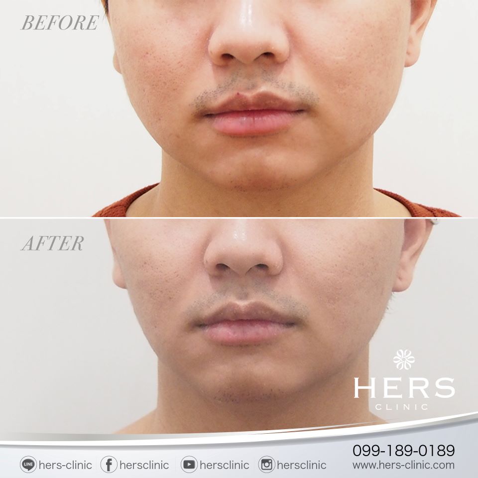 ตัดไขมันกระพุ้งแก้ม ลดแก้ม หน้าเรียว Hers Clinic