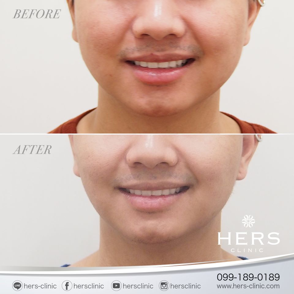 ตัดไขมันกระพุ้งแก้ม ลดแก้ม หน้าเรียว Hers Clinic