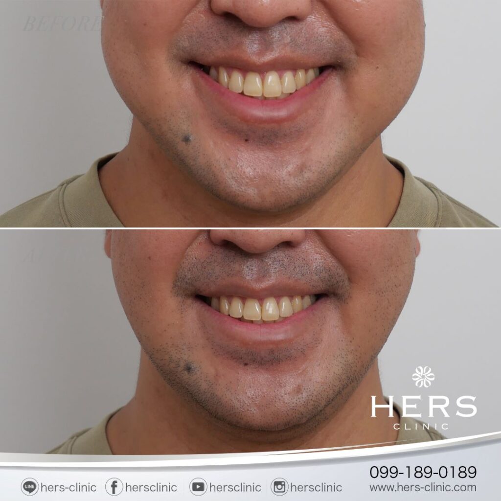 ตัดไขมันกระพุ้งแก้ม ลดแก้ม หน้าเรียว Hers Clinic