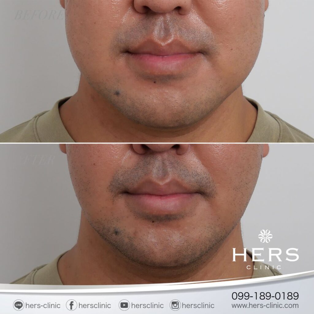ตัดไขมันกระพุ้งแก้ม ลดแก้ม หน้าเรียว Hers Clinic