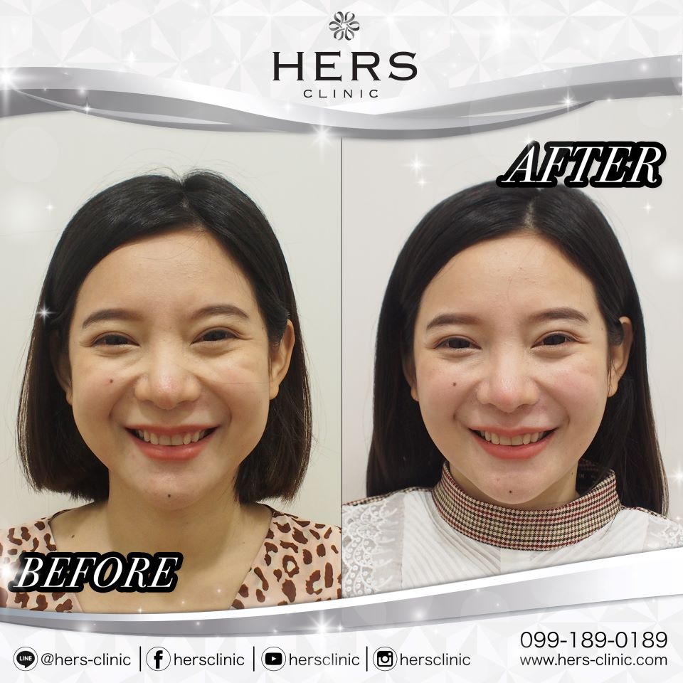 ตัดไขมันกระพุ้งแก้ม ลดแก้ม หน้าเรียว Hers Clinic