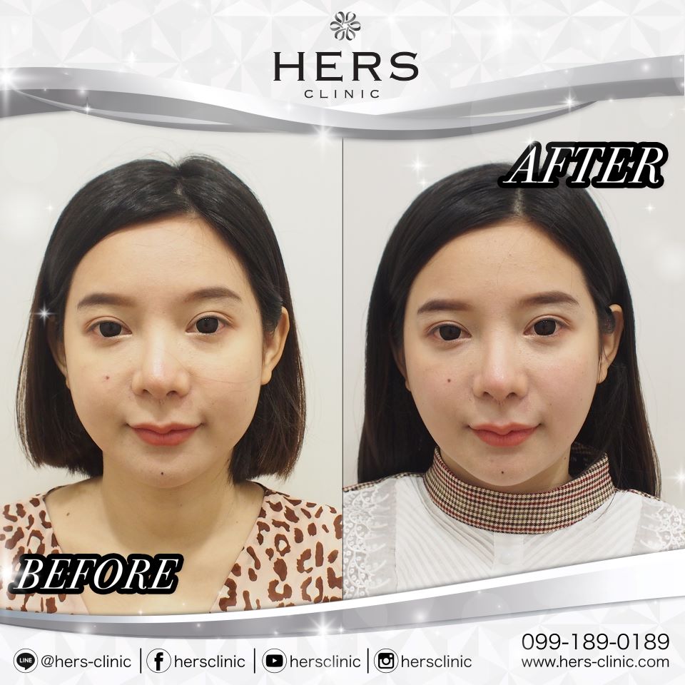 ตัดไขมันกระพุ้งแก้ม ลดแก้ม หน้าเรียว Hers Clinic
