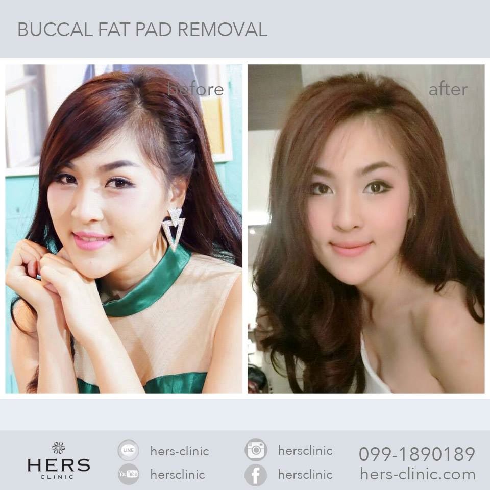 ตัดไขมันกระพุ้งแก้ม ลดแก้ม หน้าเรียว Hers Clinic