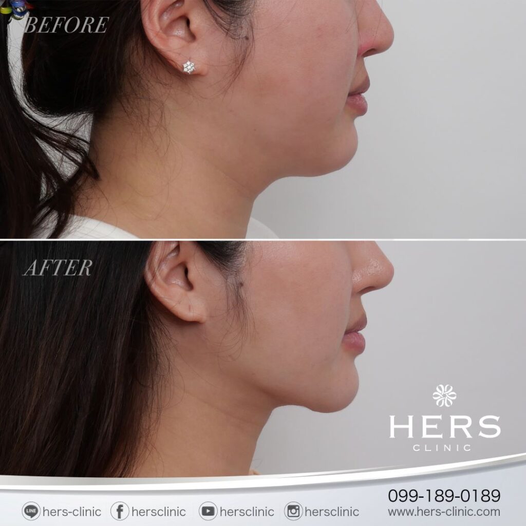 ผ่าตัดเหนียง ลดเหนียง ผ่าตัดลดเหนียง HERS CLINIC