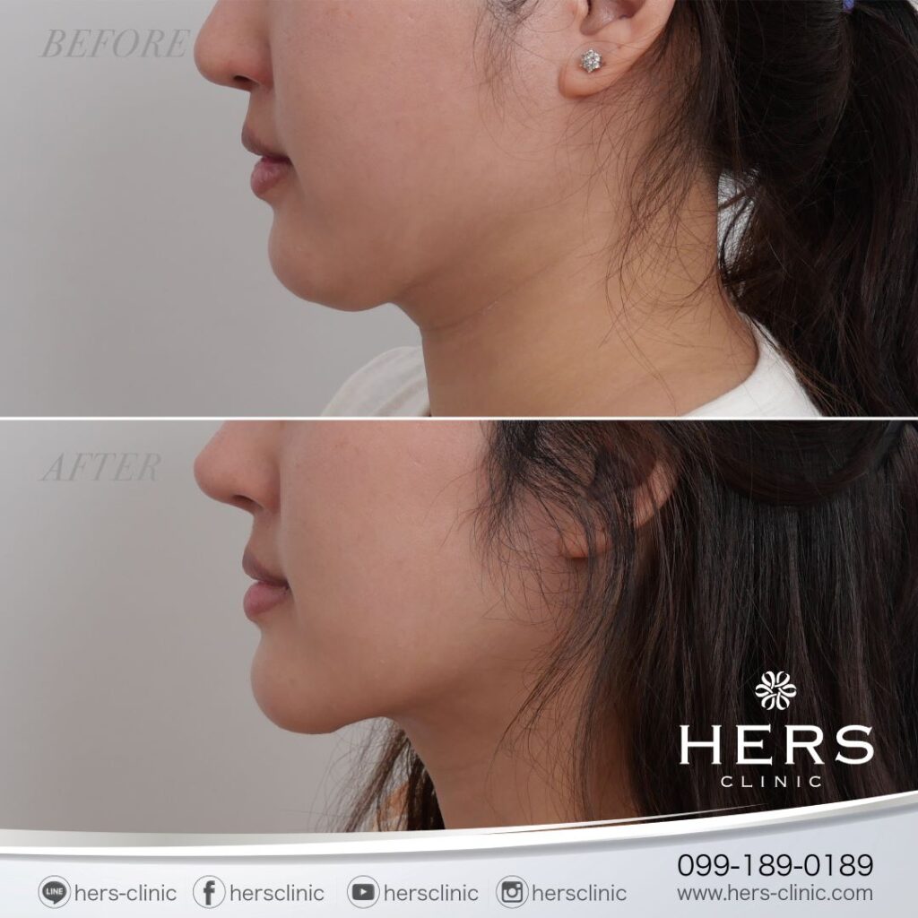 ผ่าตัดเหนียง ลดเหนียง ผ่าตัดลดเหนียง HERS CLINIC