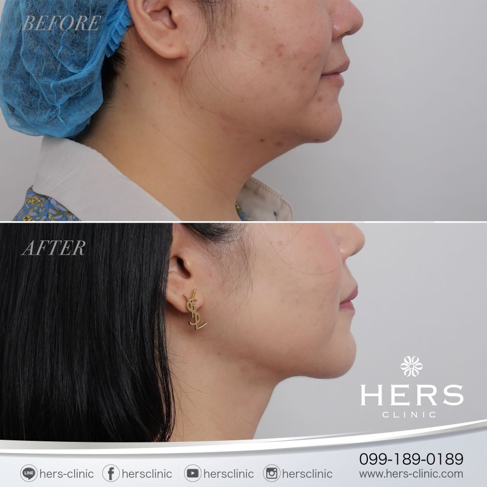 ผ่าตัดเหนียง ลดเหนียง ผ่าตัดลดเหนียง HERS CLINIC