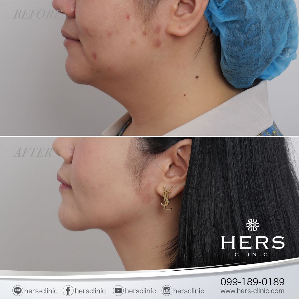 ผ่าตัดเหนียง ลดเหนียง ผ่าตัดลดเหนียง HERS CLINIC