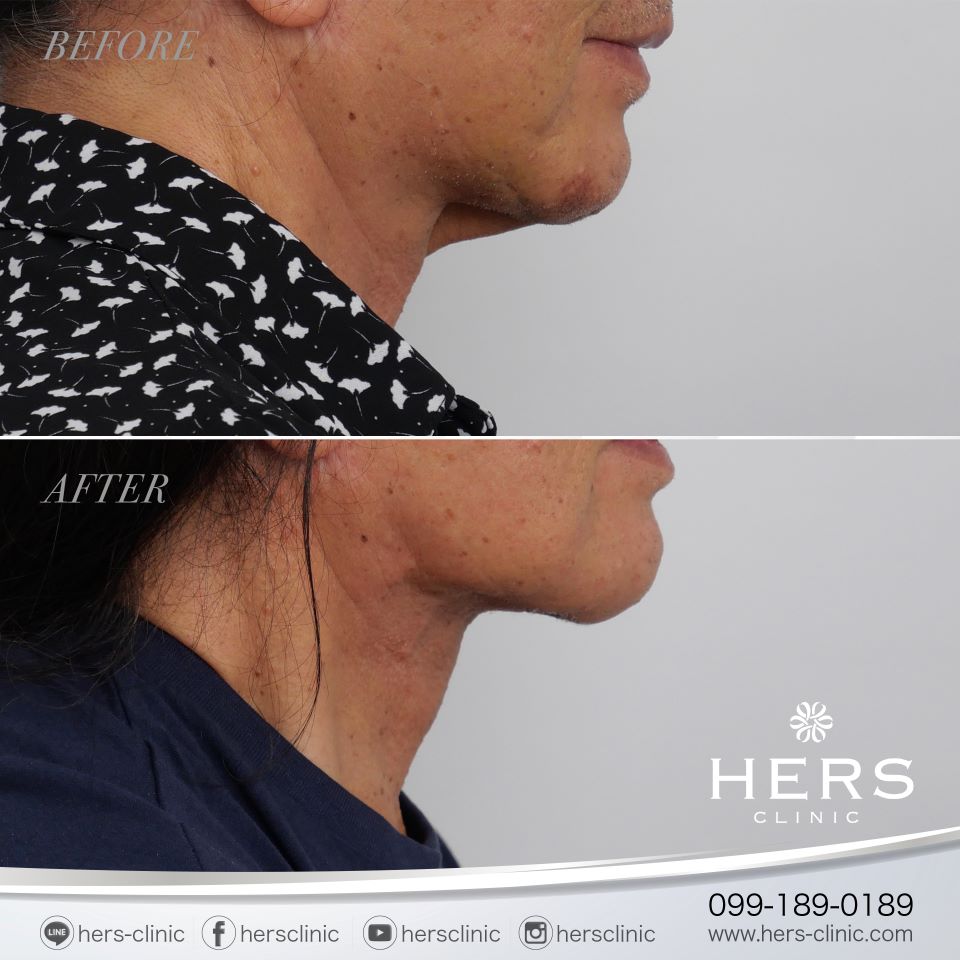 ผ่าตัดเหนียง ลดเหนียง ผ่าตัดลดเหนียง HERS CLINIC