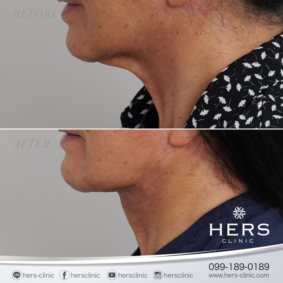 ผ่าตัดเหนียง ลดเหนียง ผ่าตัดลดเหนียง HERS CLINIC