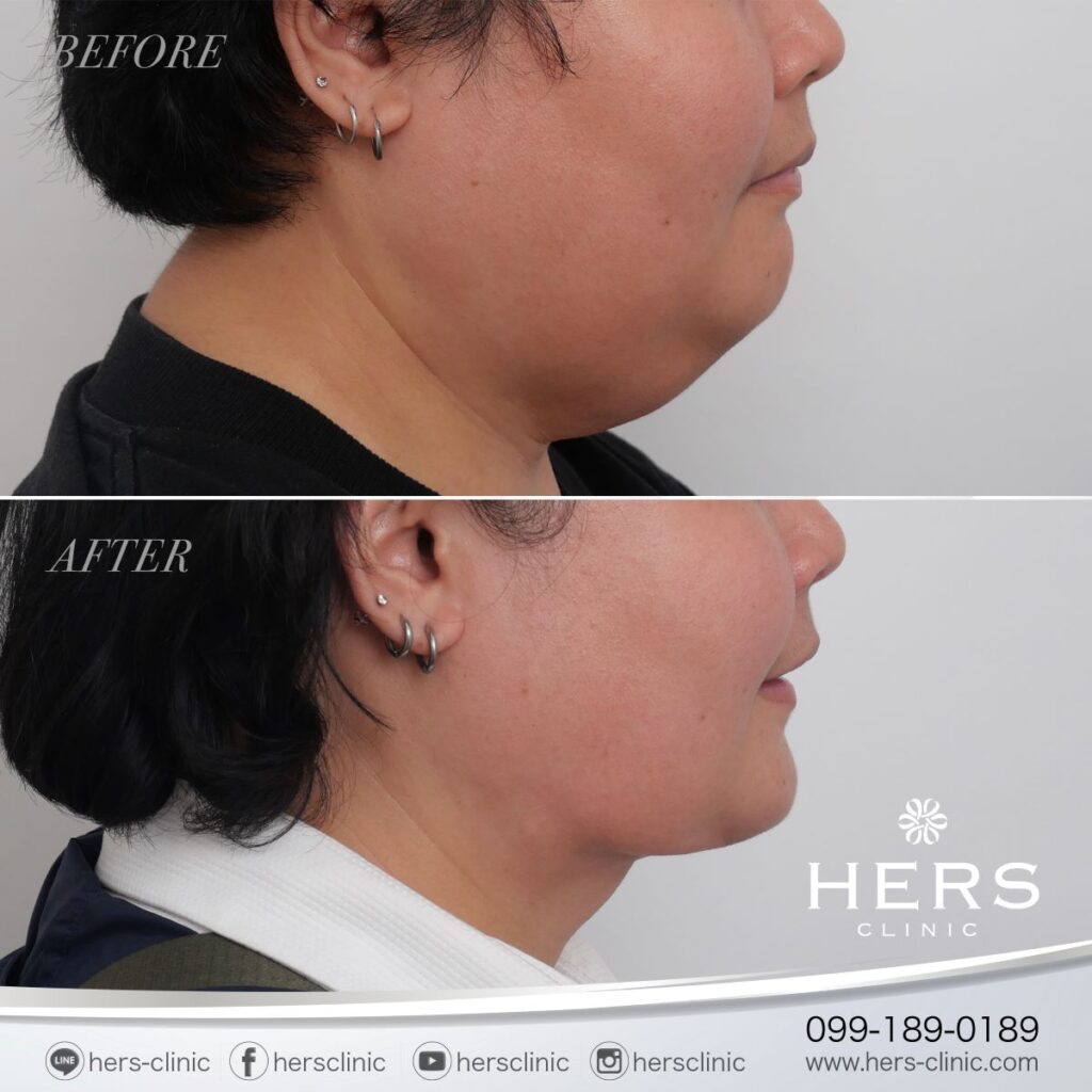 ผ่าตัดเหนียง ลดเหนียง ผ่าตัดลดเหนียง HERS CLINIC
