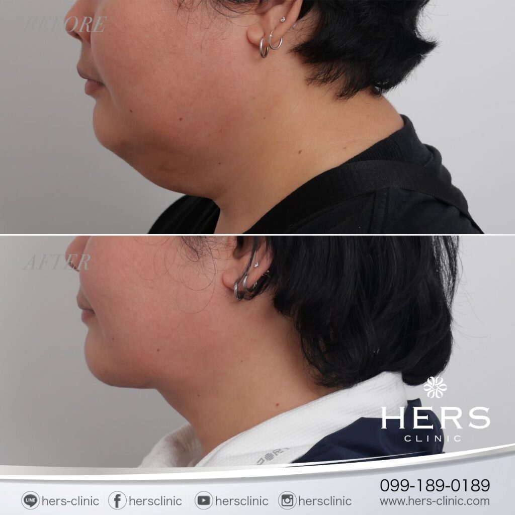 ผ่าตัดเหนียง ลดเหนียง ผ่าตัดลดเหนียง HERS CLINIC