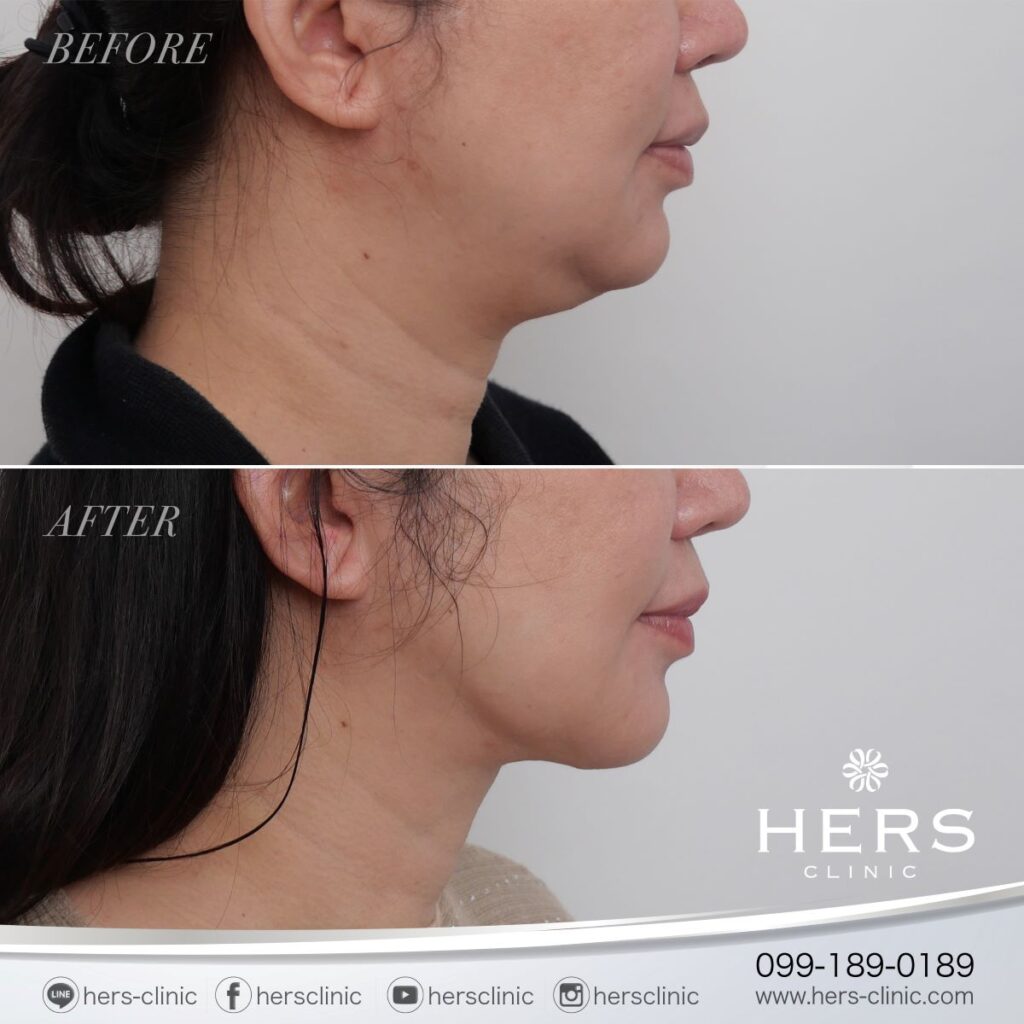 ผ่าตัดเหนียง ลดเหนียง ผ่าตัดลดเหนียง HERS CLINIC