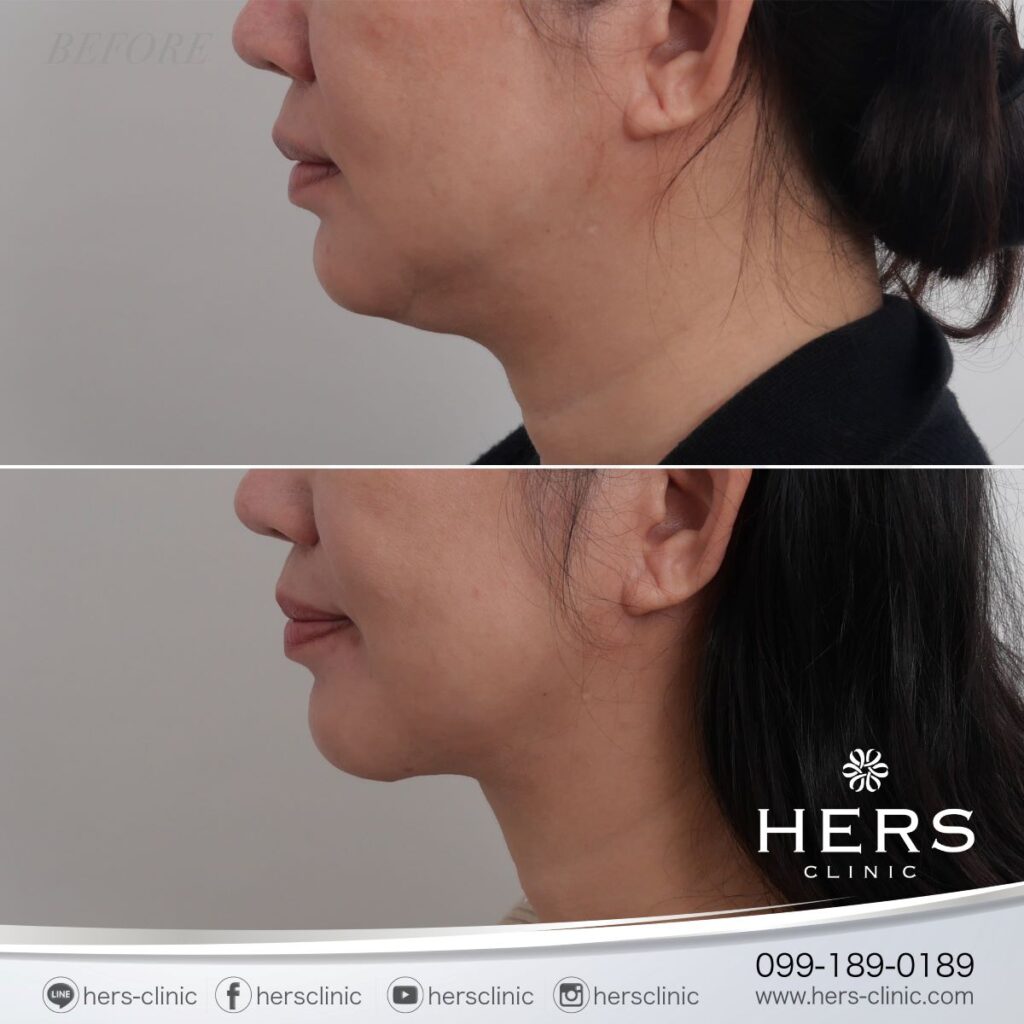 ผ่าตัดเหนียง ลดเหนียง ผ่าตัดลดเหนียง HERS CLINIC