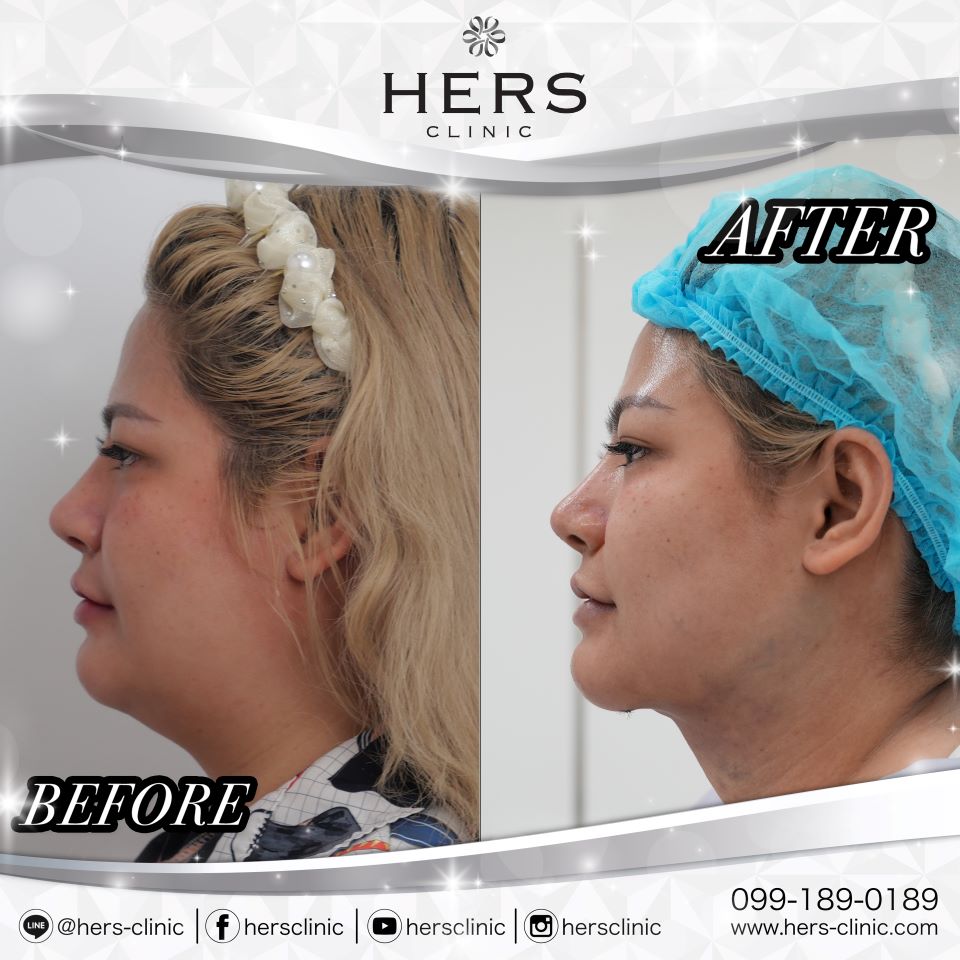 ผ่าตัดเหนียง ลดเหนียง ผ่าตัดลดเหนียง HERS CLINIC