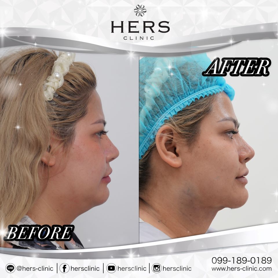 ผ่าตัดเหนียง ลดเหนียง ผ่าตัดลดเหนียง HERS CLINIC