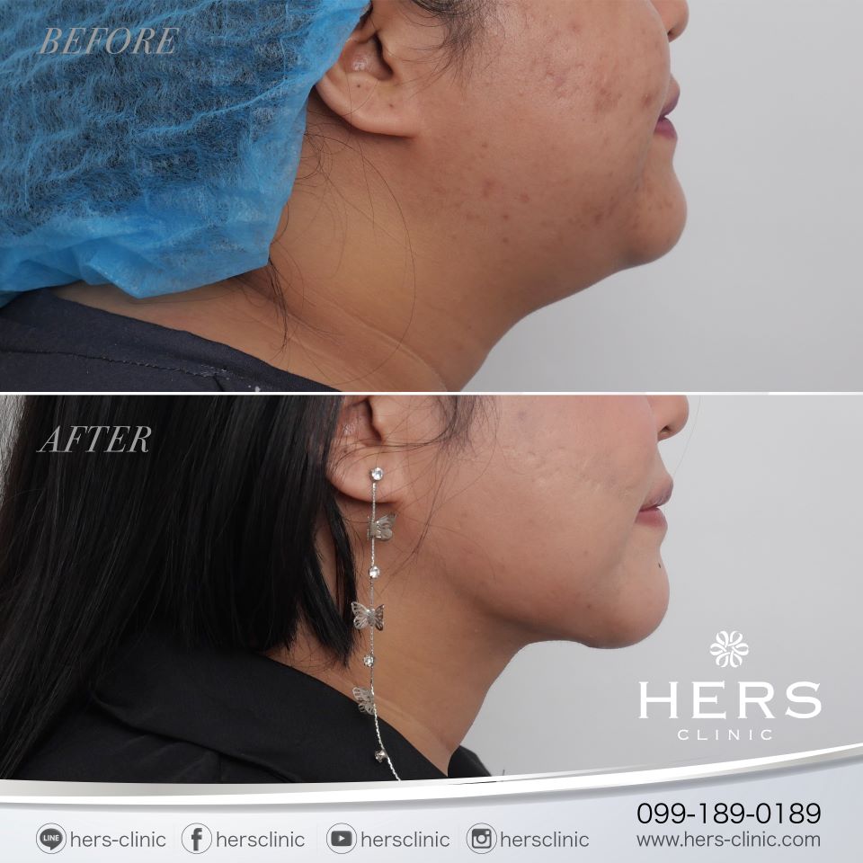 ผ่าตัดเหนียง ลดเหนียง ผ่าตัดลดเหนียง HERS CLINIC