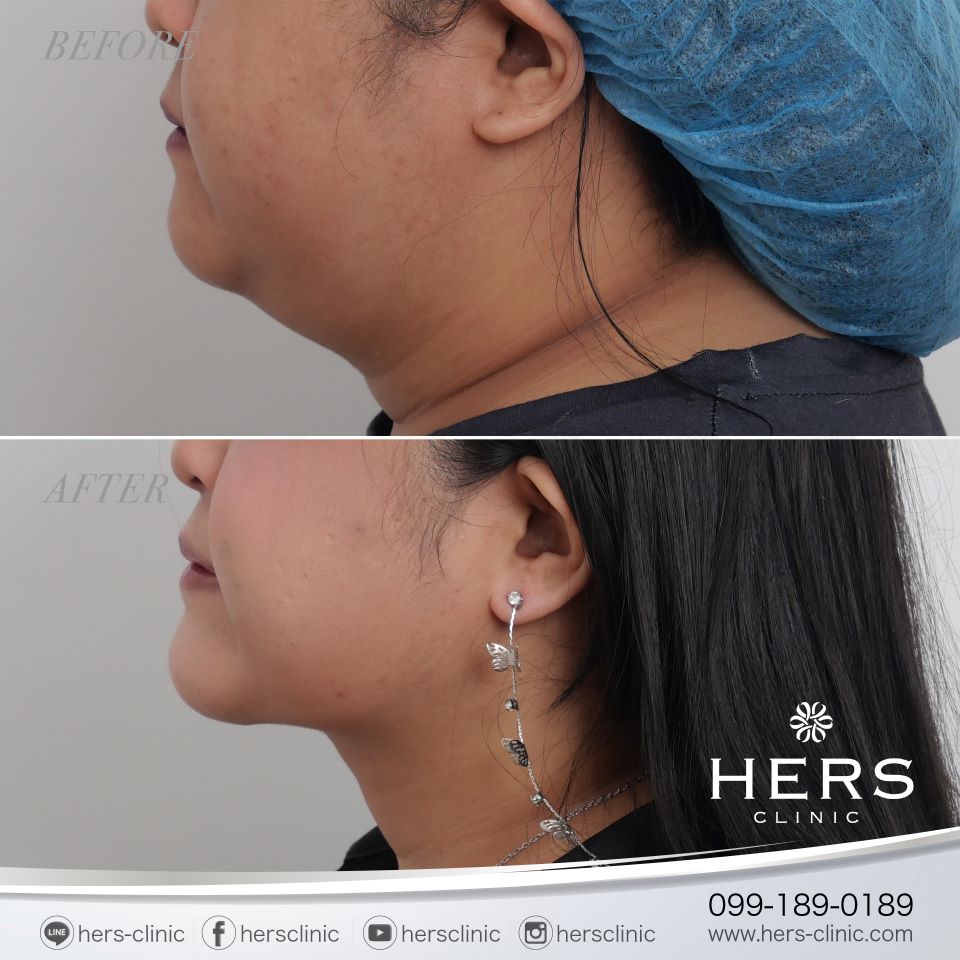 ผ่าตัดเหนียง ลดเหนียง ผ่าตัดลดเหนียง HERS CLINIC