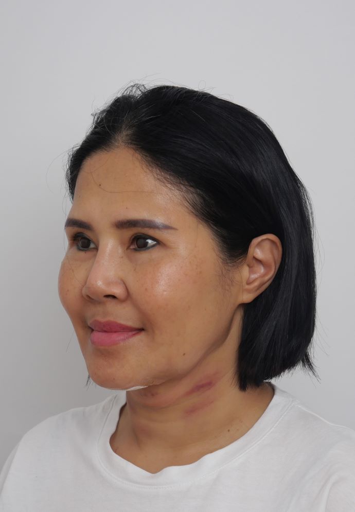อาการบวมหลังตัดเหนียง Hers Clinic