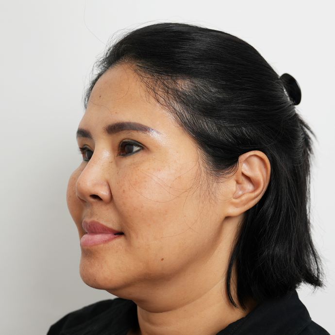 ตัดเหนียง Hers Clinic