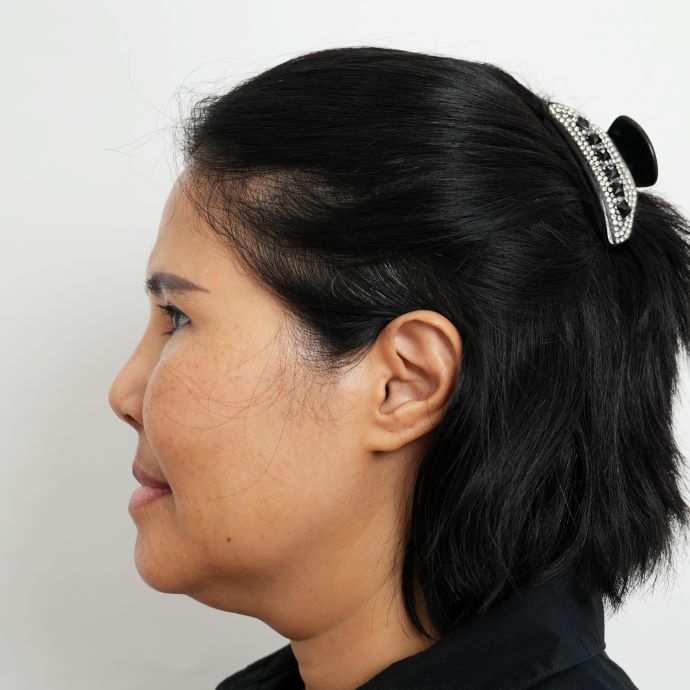 ตัดเหนียง Hers Clinic