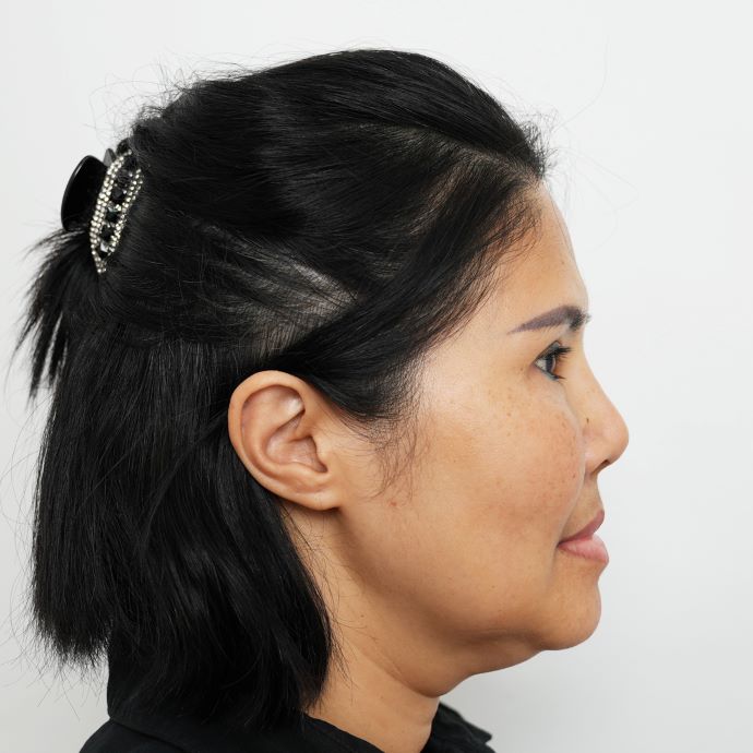 ตัดเหนียง Hers Clinic
