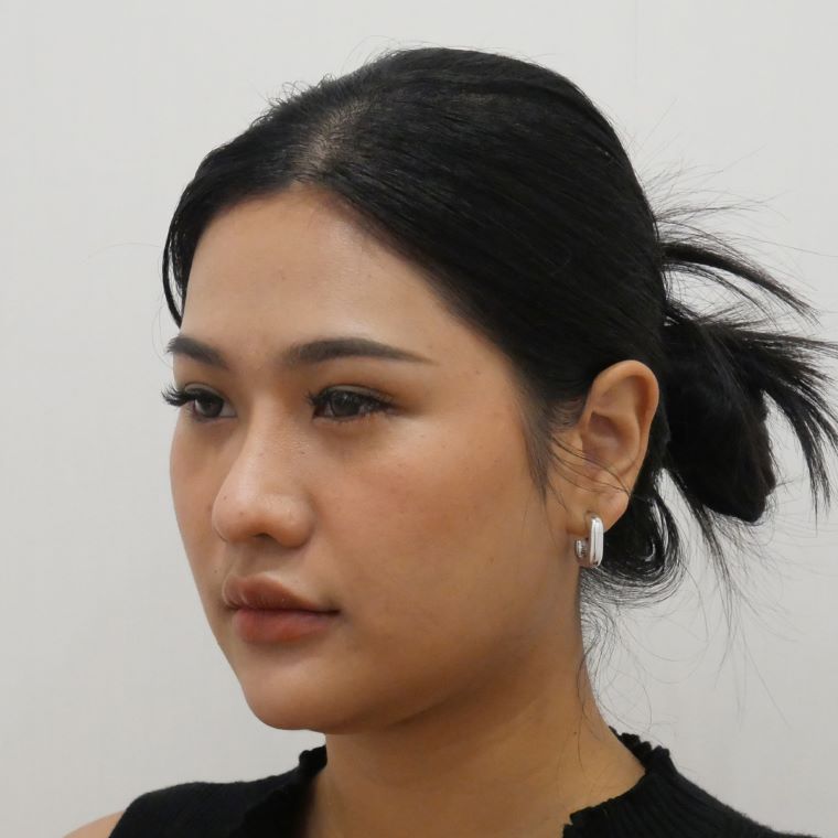 ตัดเหนียง Hers Clinic