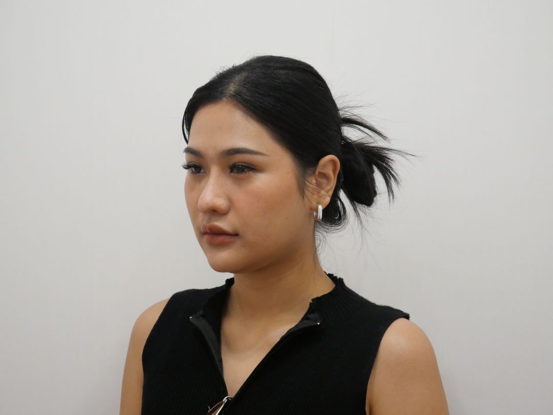 ตัดเหนียง Hers Clinic