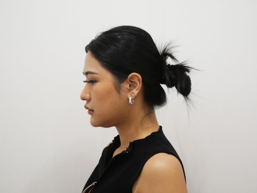 ตัดเหนียง Hers Clinic