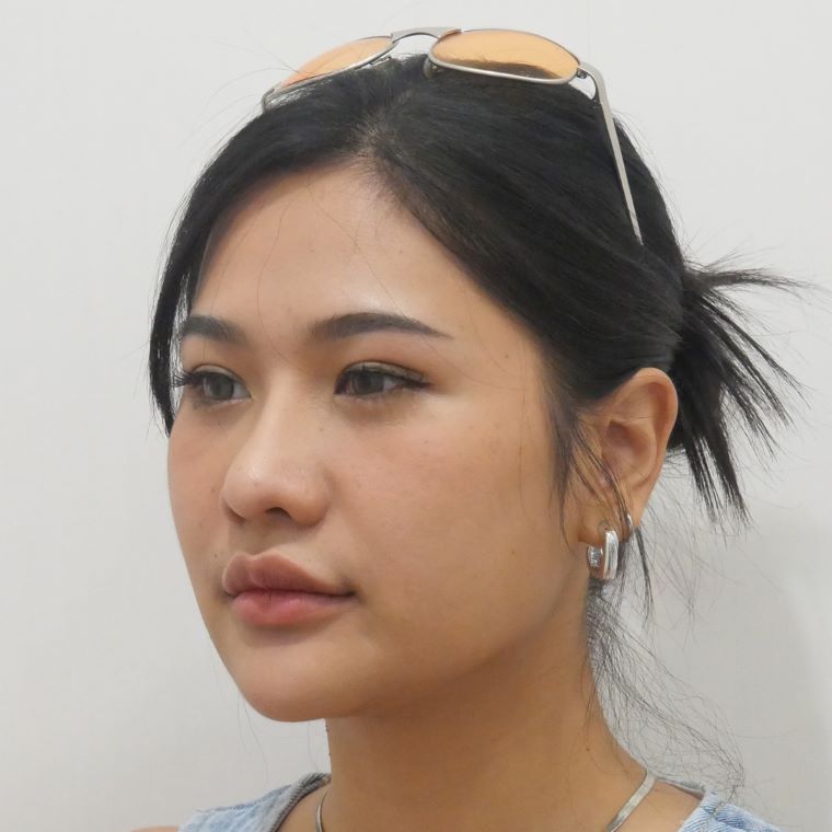 ตัดเหนียง Hers Clinic