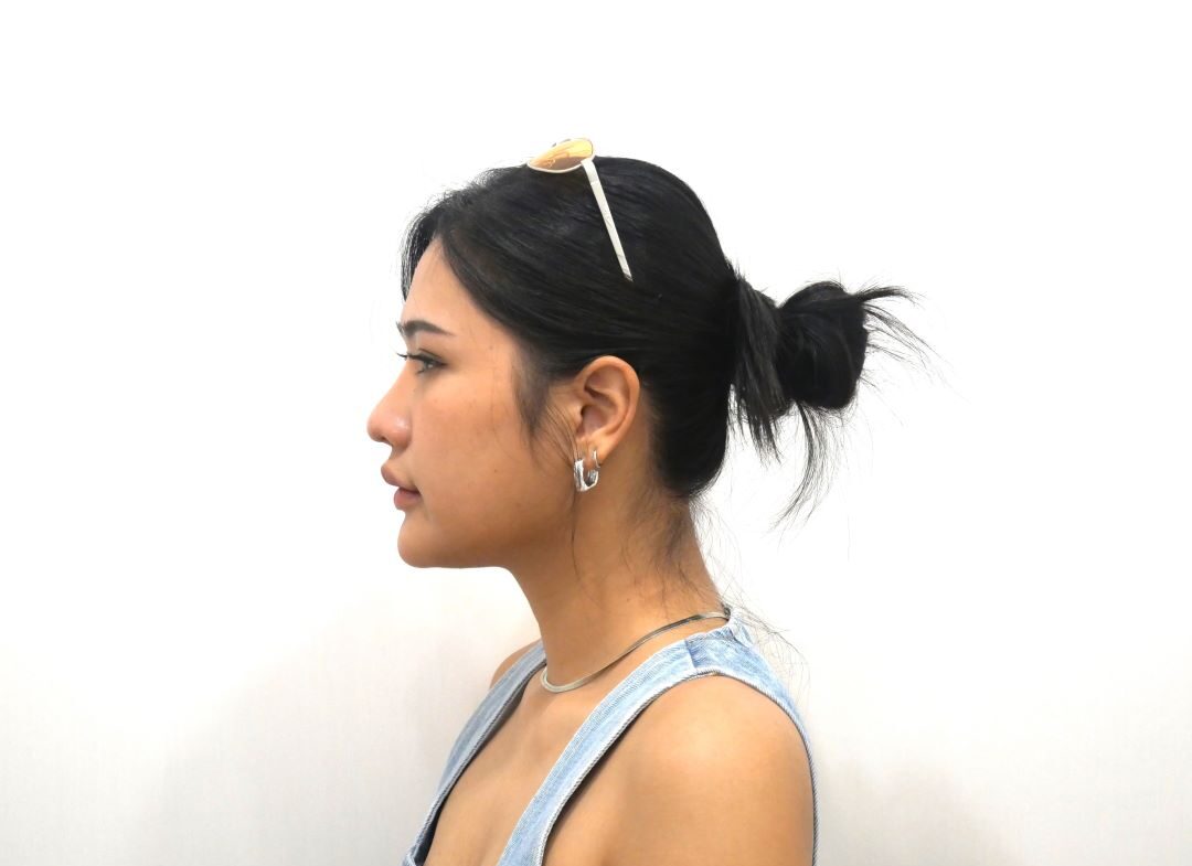 ตัดเหนียง Hers Clinic