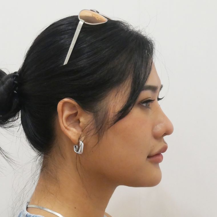 ตัดเหนียง Hers Clinic