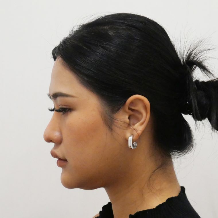 ตัดเหนียง Hers Clinic