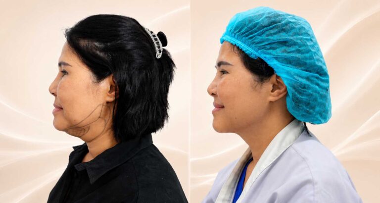 ตัดเหนียง Hers Clinic